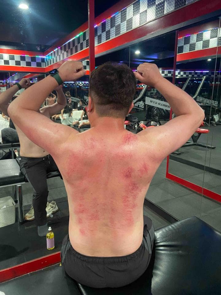 這張照片是一個男子坐在健身房的椅子上,他背部有很多紅色的按摩痕跡。