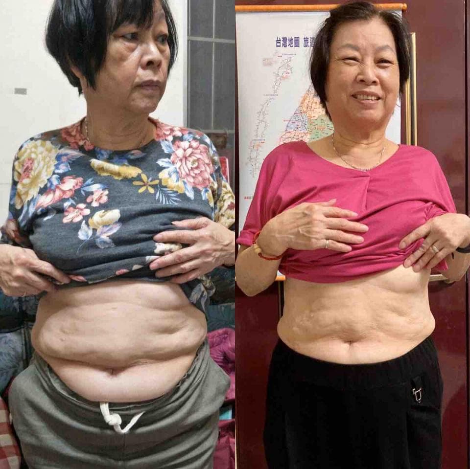 這張照片是一個女性的減肥前後對比照,照片的重點是展示她減肥後明顯的腹部變化,她左側的照片顯示了減肥前略顯肥胖的腹部,而右側的照片則展現出減肥後平坦緊致的腹部,對比非常明顯。